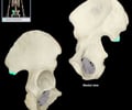 Image: posterior inferior iliac spine (PIIS)