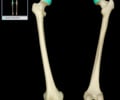 Image: head of femur