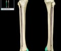 Image: medial malleolus