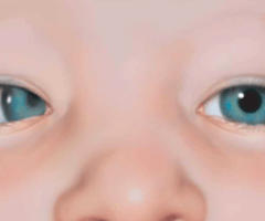 Image: esotropia