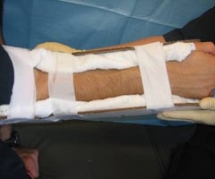 Image: splint